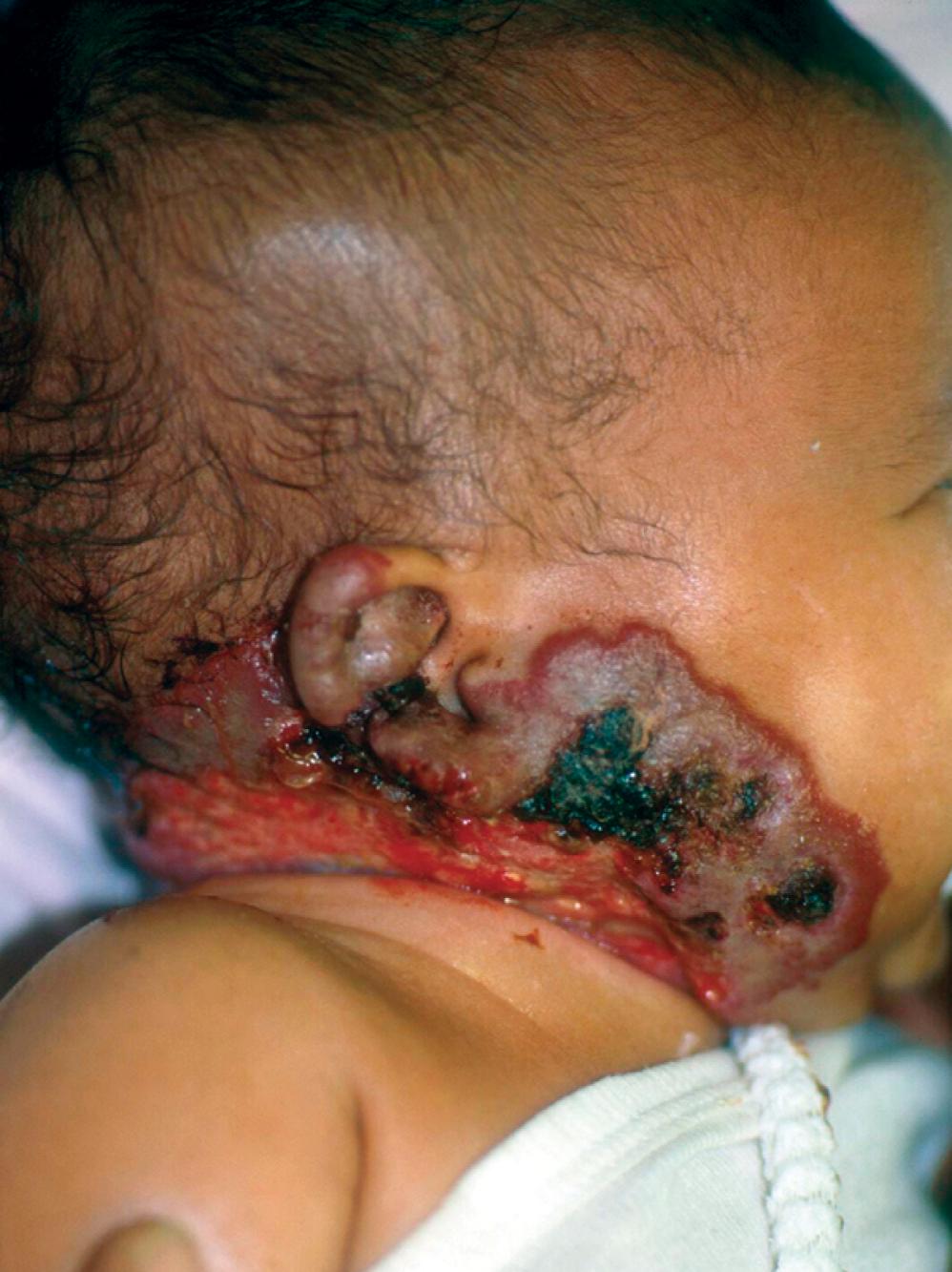 Fig. 25.11, Ulcerated hemangioma of infancy of the ear and neck.