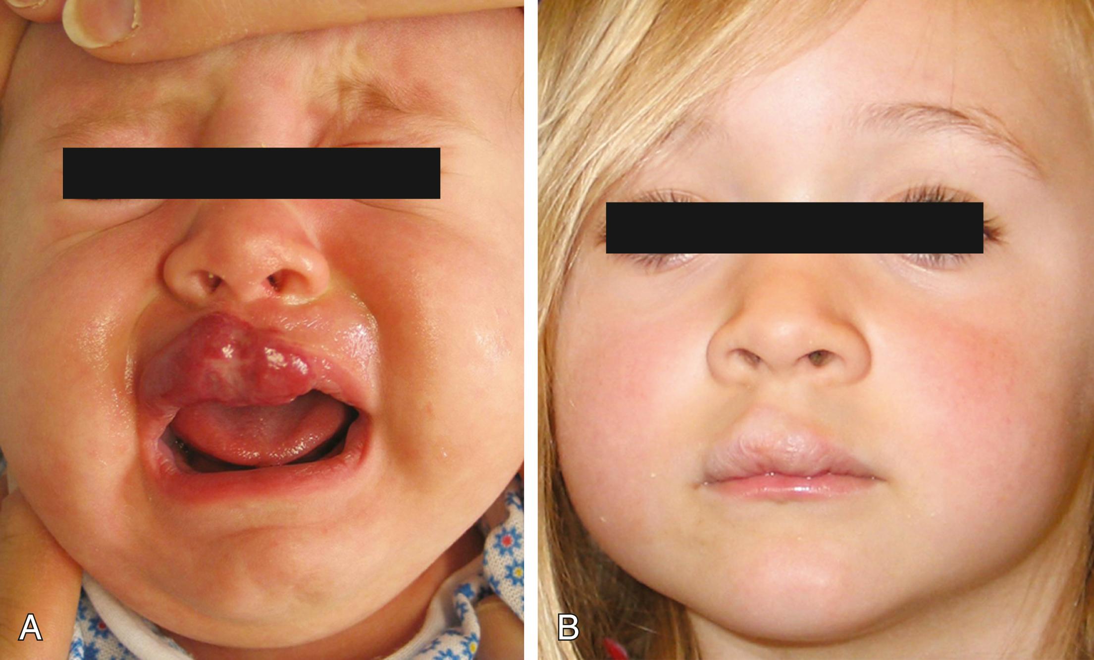 Fig. 25.12, Hemangioma of infancy; lip. (A) Ulcerated hemangioma during proliferation. (B) Lip appearance after several pulsed-dye laser treatments and ulcer healing.