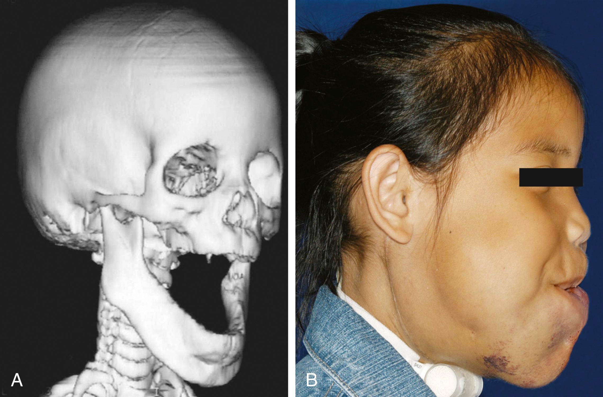 Fig. 25.2, Mandibular overgrowth associated with lymphatic malformation. (A) Three-dimensional computed tomography reconstruction in infancy. (B) Clinical image of the same patient at a later age.