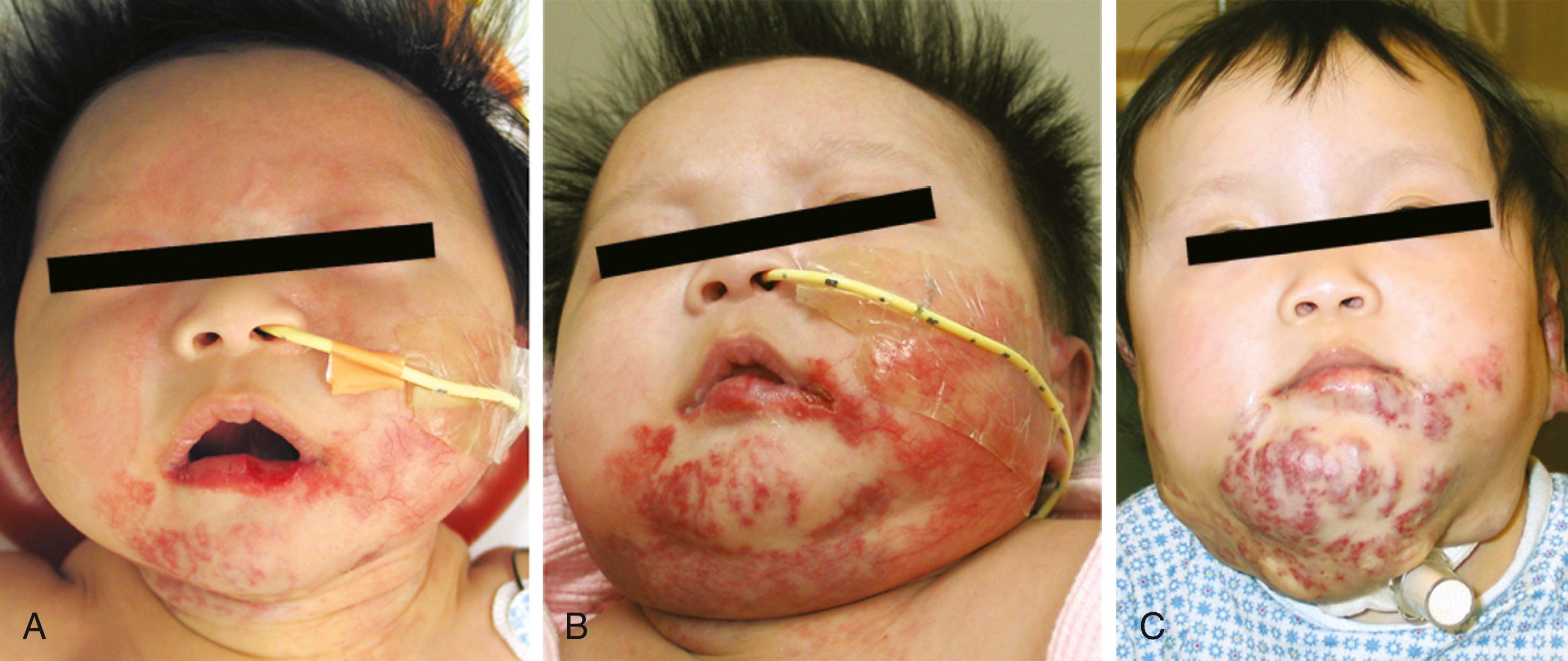 Fig. 25.3, Segmental hemangioma appearance. (A) Initial appearance in infancy. (B) Late proliferative stage. (C) Beginning involution phase.