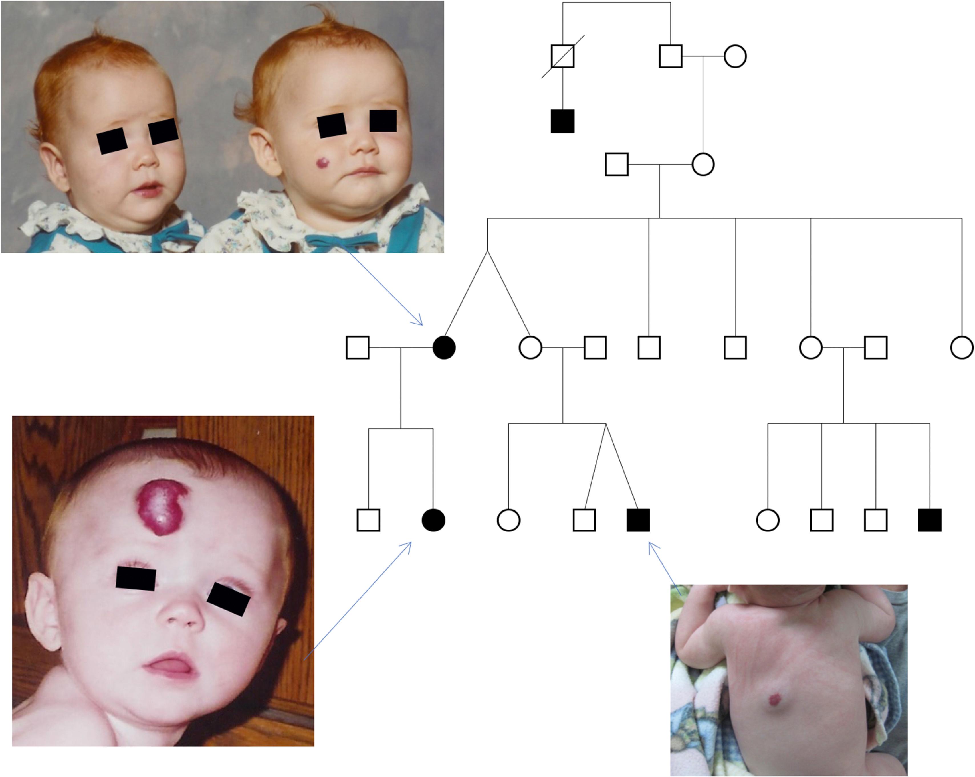 Fig. 25.4, Pedigree of familial hemangiomas. Shaded symbols indicate individuals with hemangiomas. Squares indicate males; circles, females; slash, deceased.