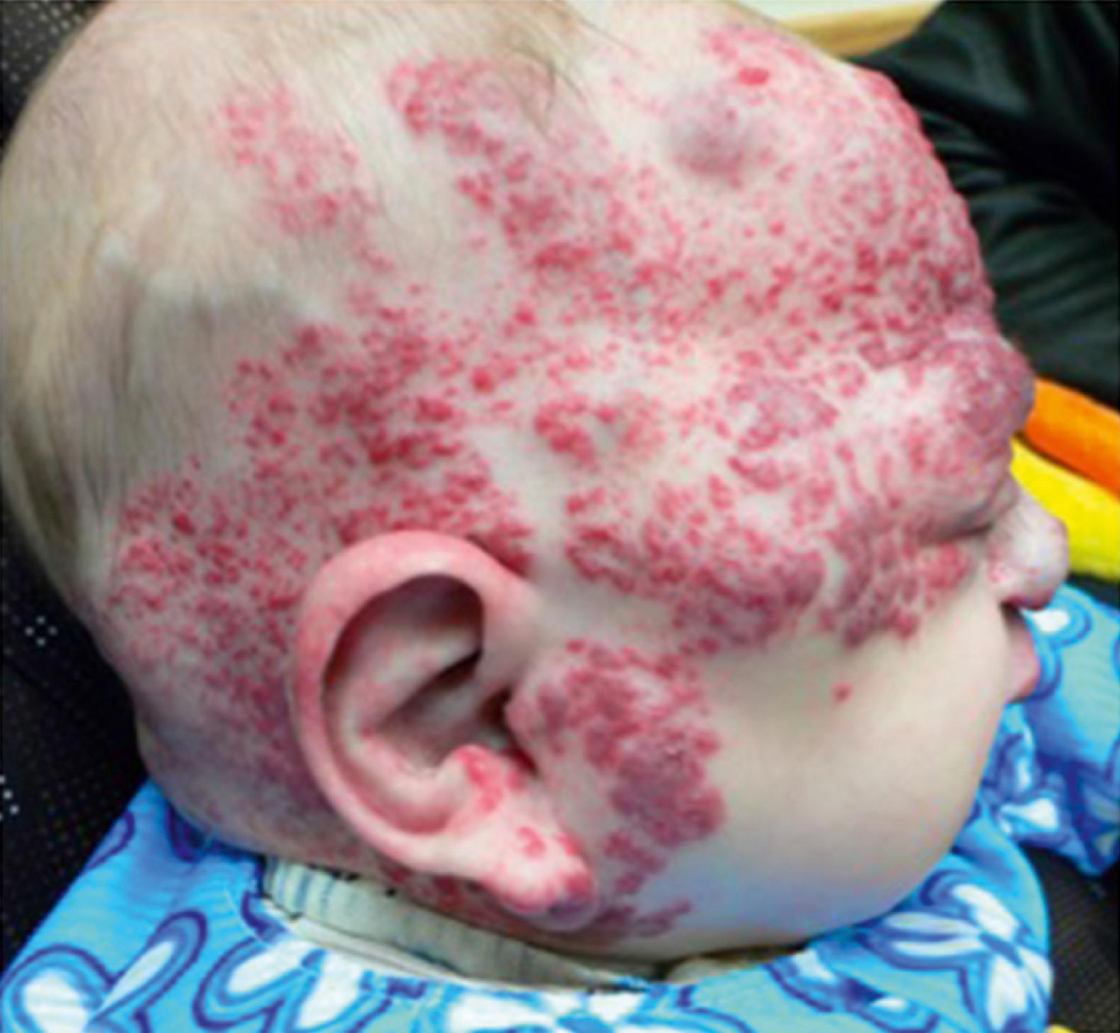 Fig. 25.5, Large segmental hemangioma involving facial dermatome.