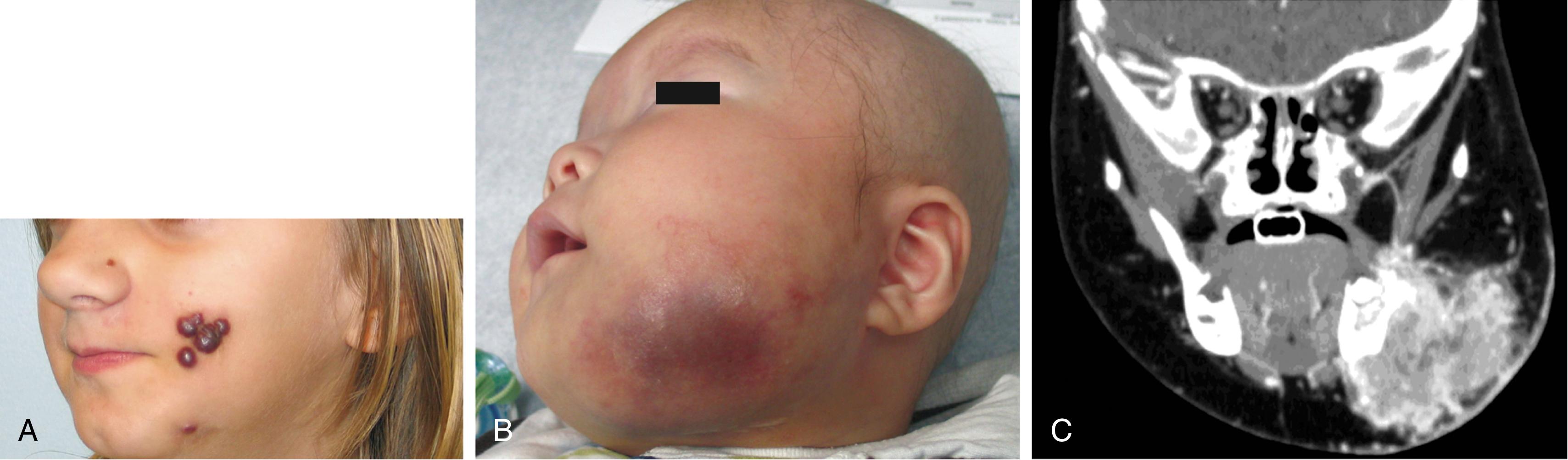 Fig. 25.8, Kaposiform hemangioma endothelioma, clinical and radiographic appearances. (A) Cutaneous nodules. (B) Deep lesion that extends to the skin. (C) Coronal computed tomography scan of the lesion shown in B.