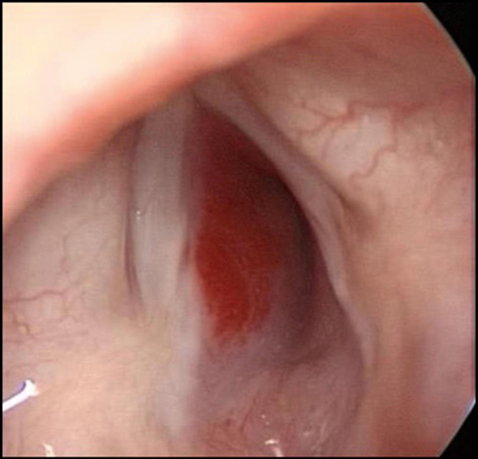 Fig. 25.9, Endoscopic appearance of airway hemangioma involving the subglottis.