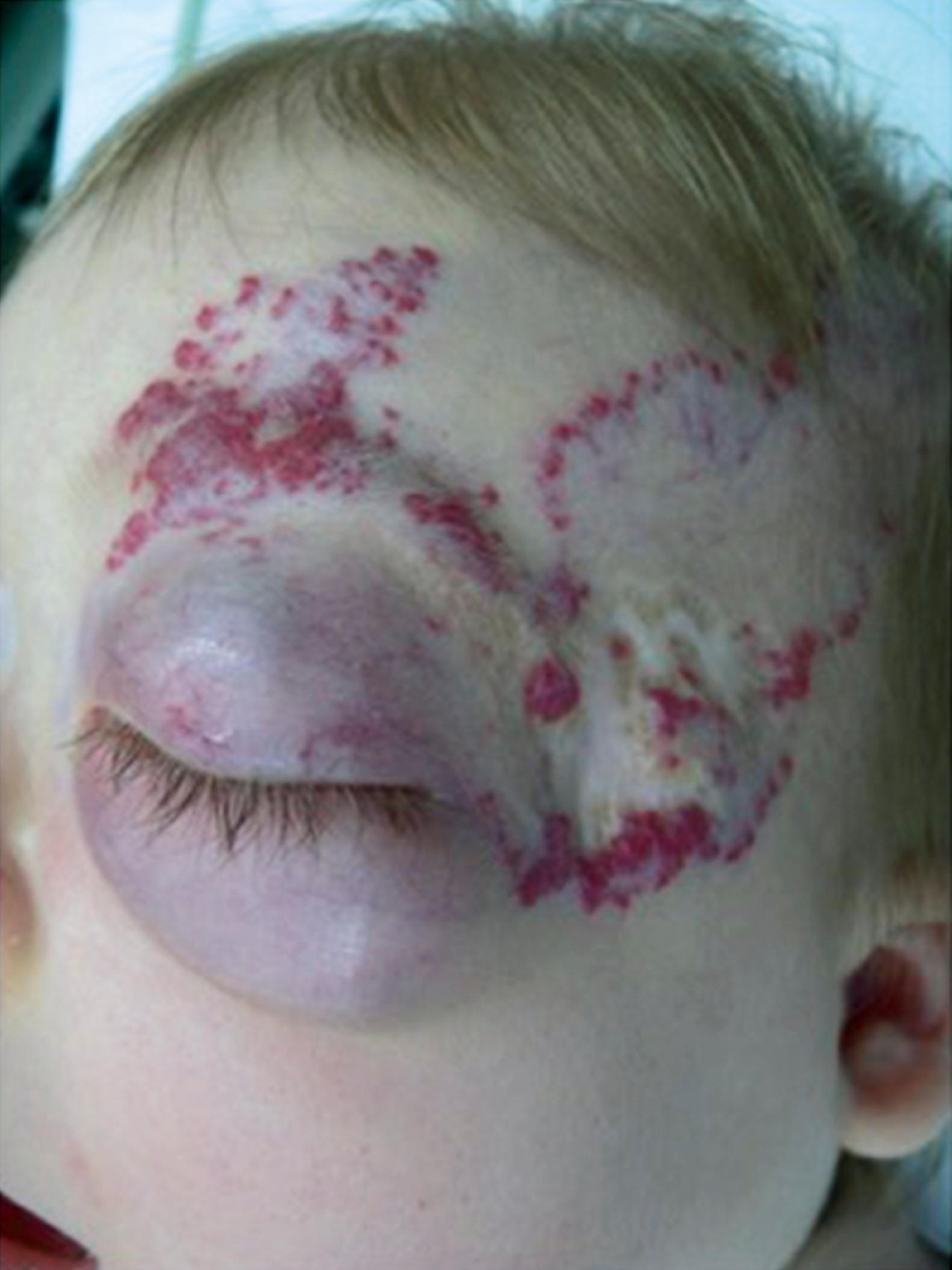 Fig. 25.10, Deep focal hemangioma of infancy of the upper eyelid that impinges on the visual axis.