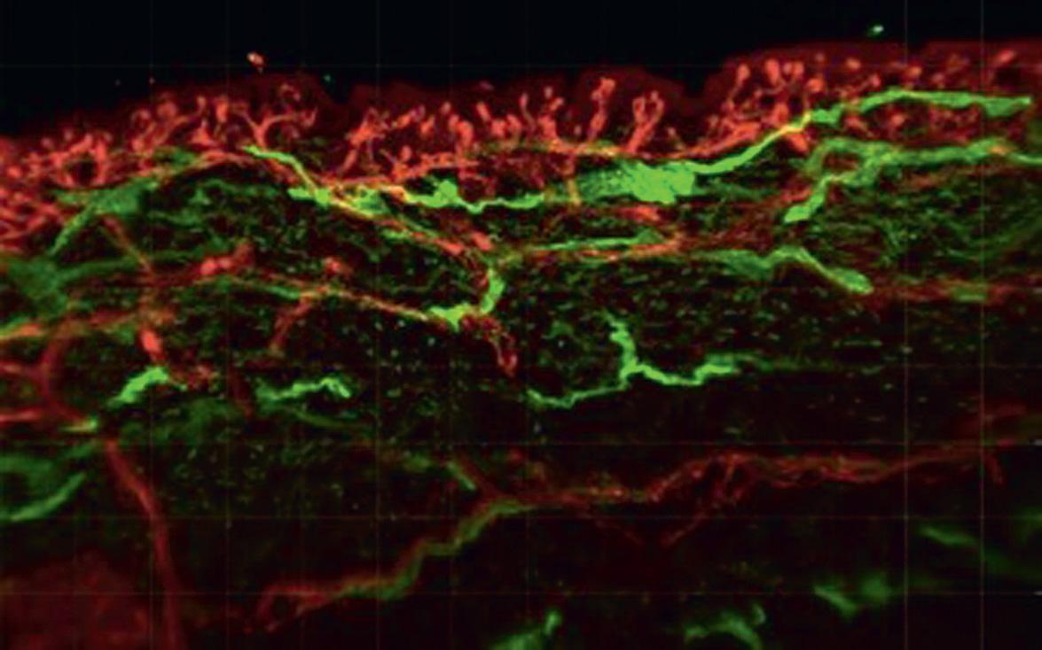 Fig. 102.3, Light-sheet fluorescent microscopy depicting distinct staining of cutaneous blood vessels and lymphatic vessels in human skin.