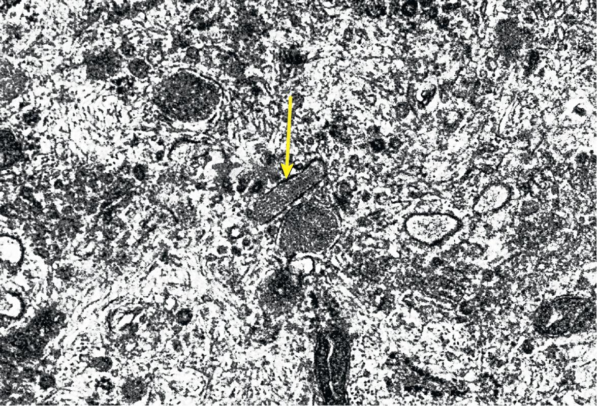 Fig. 102.5, Ultrastructural visualization of a rod-shaped Weibel–Palade body (WPB; arrow) within the cytoplasm of a human endothelial cell.