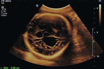 Fig. 42.2, Grayscale image of vein of Galen malformation.