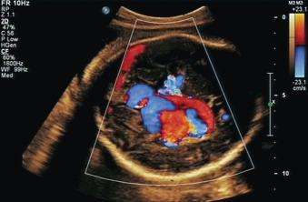 Fig. 42.3, Color flow mapping of vein of Galen malformation. Note high-velocity turbulent flow showing aliasing.