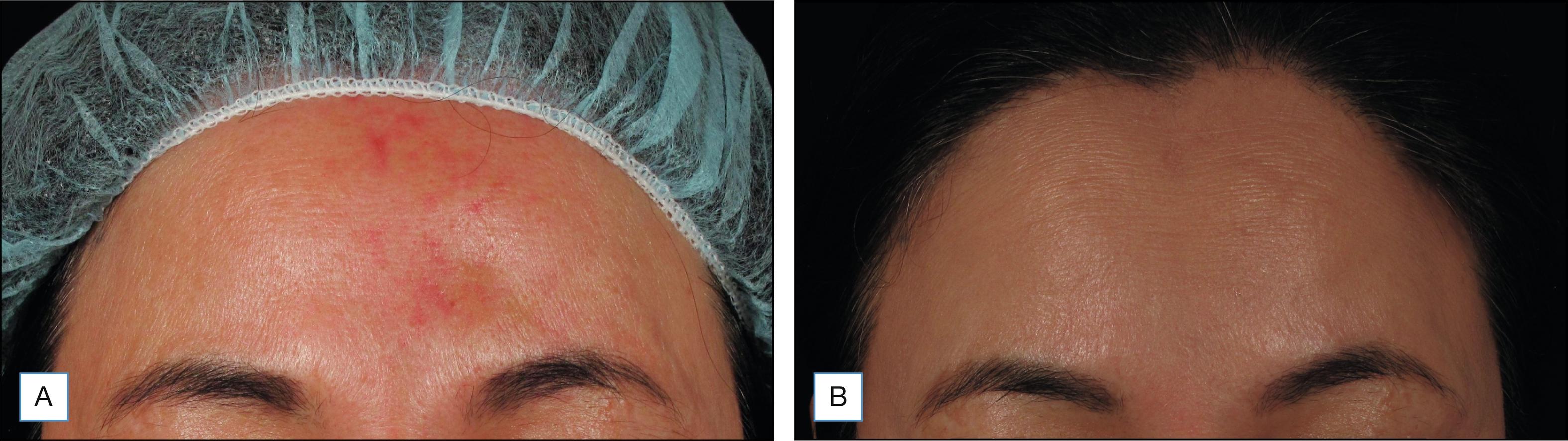 Fig. 37.1, Mottled erythema to forehead, 5 days post injection (A). Resolution of vascular compromise with no sequelae, 2.5 months post injection (B).