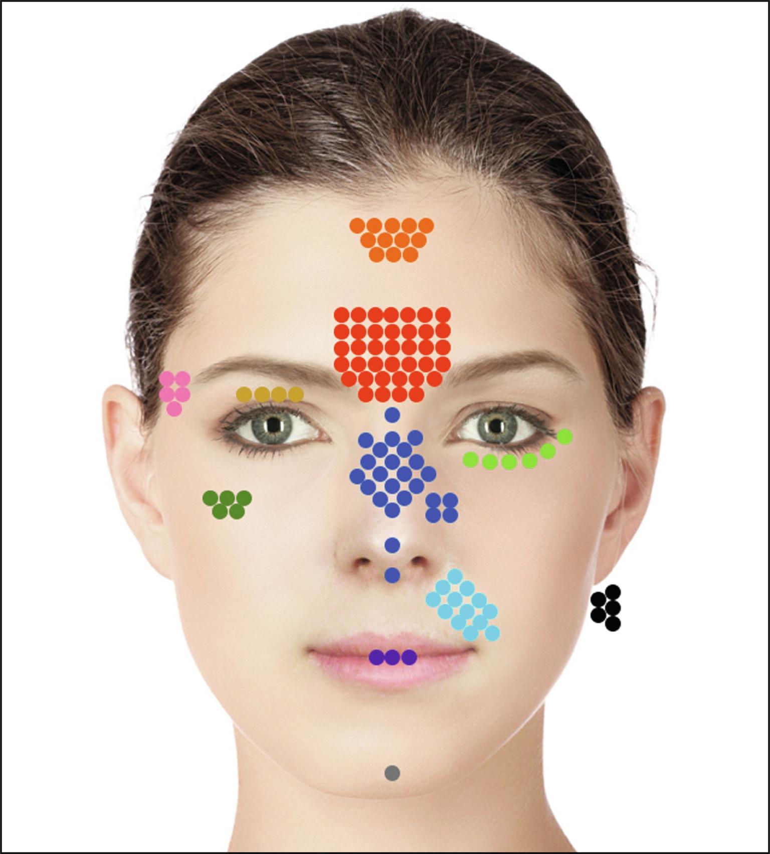 Fig. 37.2, The colored dots are the location of injection for each case of blindness from filler. The five black dots represent cases in which the location was not specified and listed as “face.”