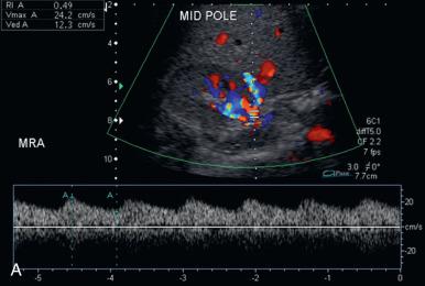 Figure 116.1, Renal artery stenosis.