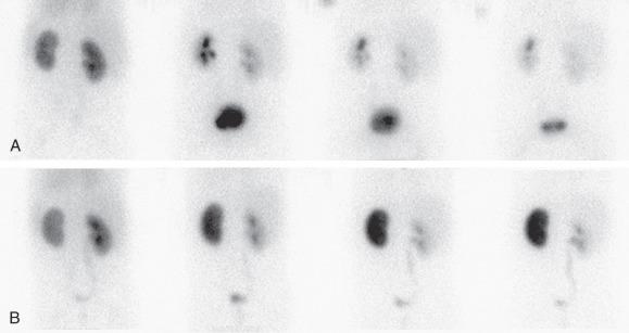 Figure 116.2, Renovascular hypertension and angiotensin-converting enzyme (ACE) inhibition scintigraphy.