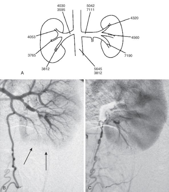 e-Figure 116.3, Hypertension in an 11-year-old girl.