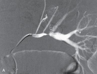 Figure 116.4, Renal artery stenosis.