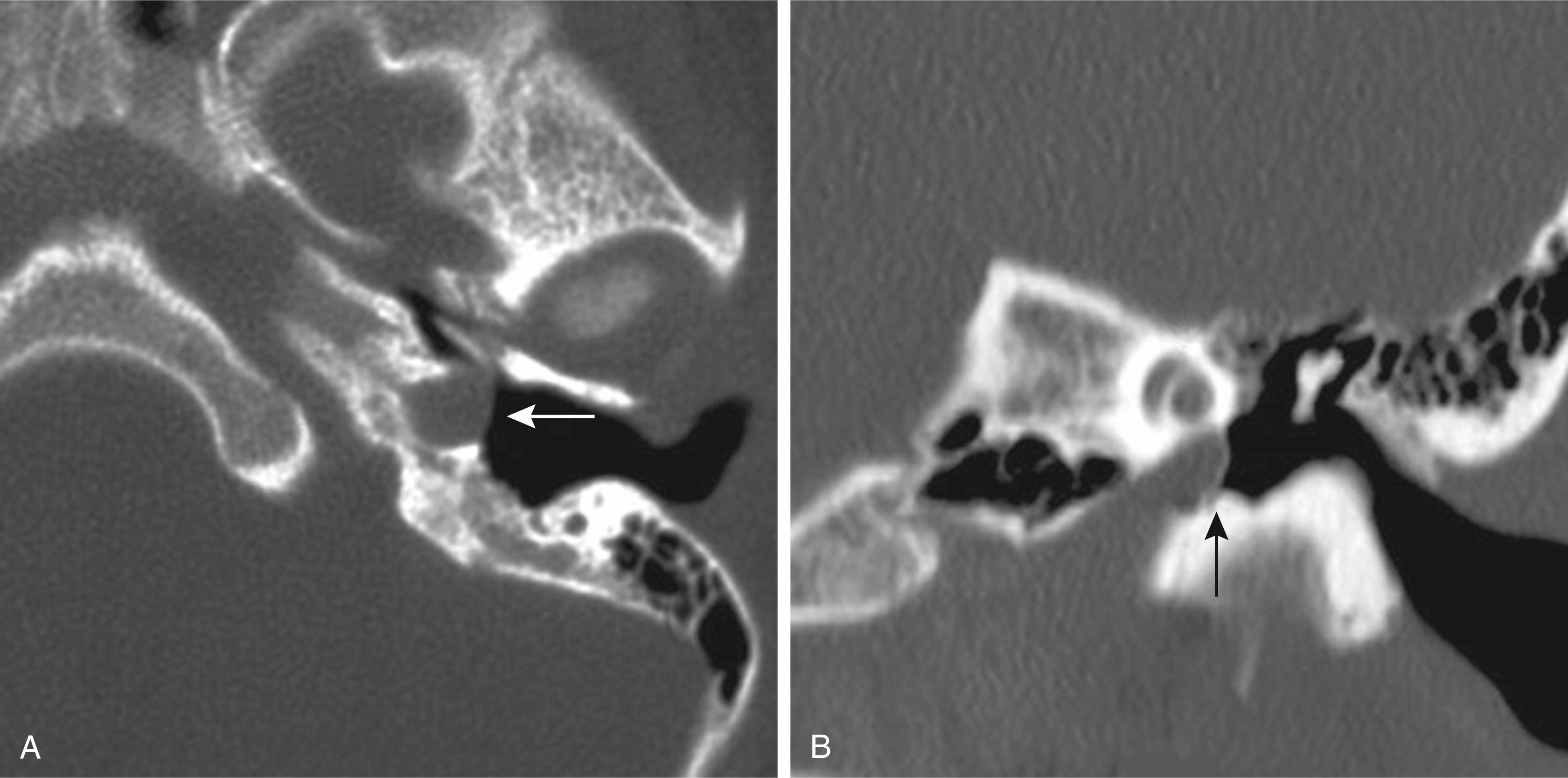 Fig. 60.1, (A) Axial computed tomography (CT) through the left temporal bone shows a distal cervical internal carotid artery (ICA) without a bony covering along the lateral margin ( white arrow ). The artery is protruding into the anteroinferior middle ear. (B) On a coronal CT, the left ICA extends more laterally into the middle ear then the cochlea ( black arrow ).