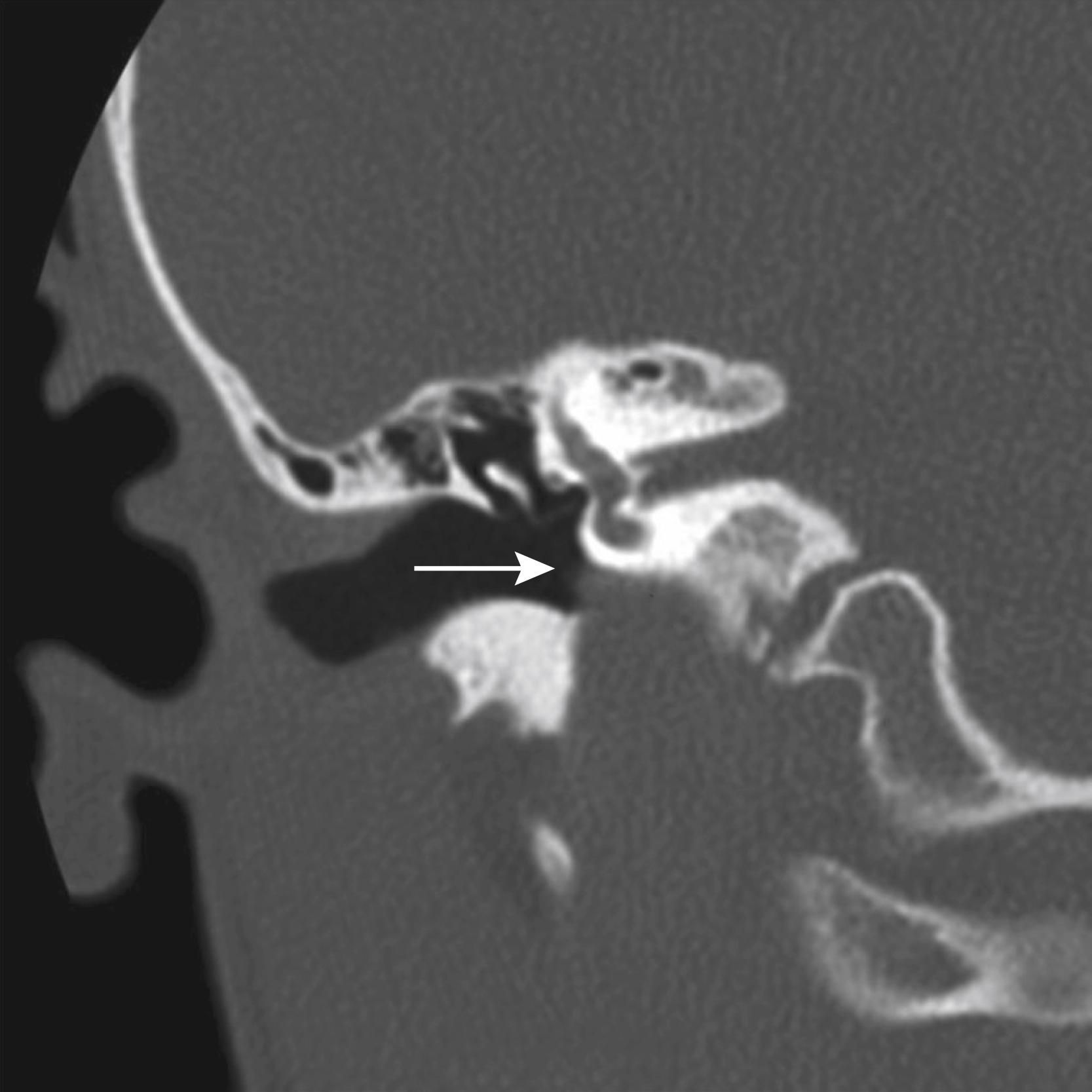 Fig. 60.2, Coronal computed tomography demonstrating a high jugular bulb with a dehiscent sigmoid plate. There is protrusion of the jugular bulb ( white arrow ) into the mesotympanum.