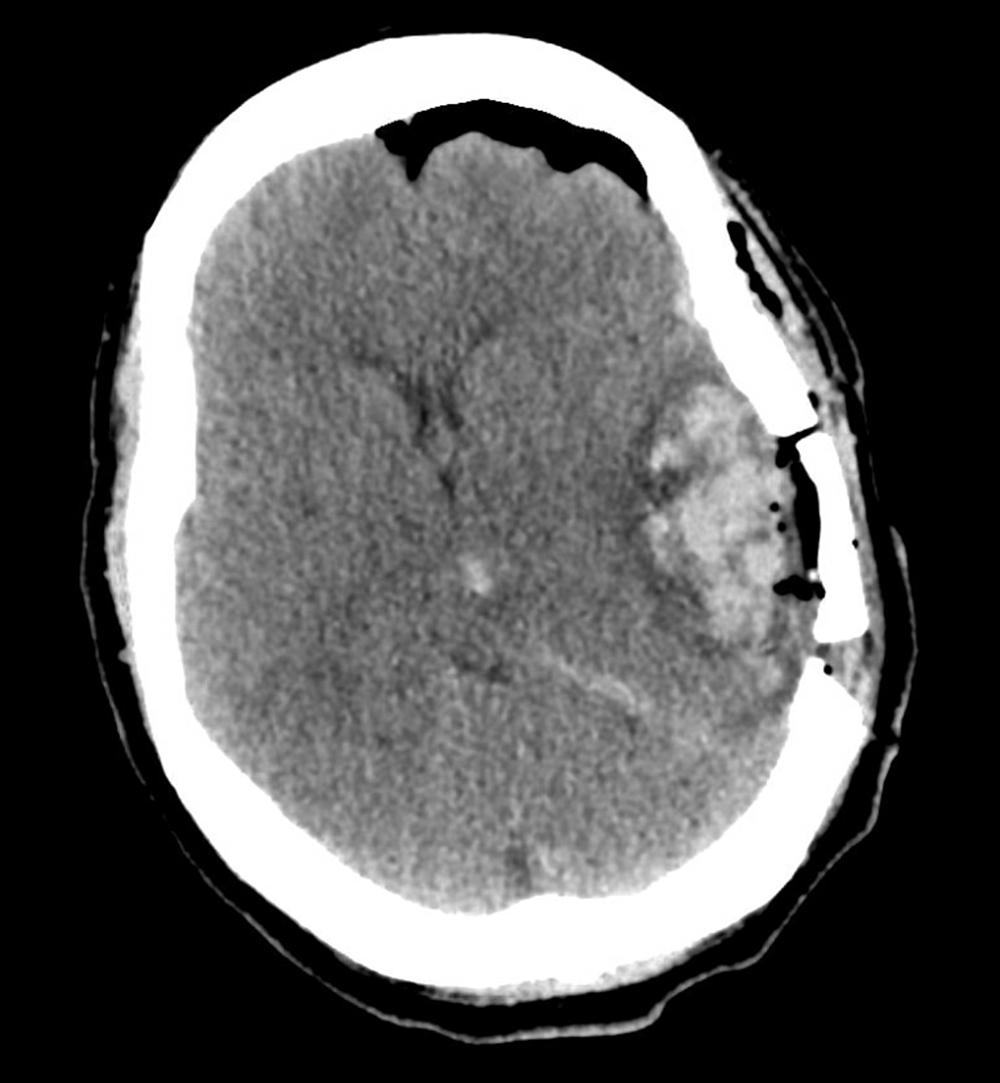 Fig. 60.3, Axial head computed tomography with brain window demonstrating a 5-cm left temporal lobe intraparenchymal hematoma due to vein of Labbé infarct following a combined middle-posterior fossa petrosal approach.