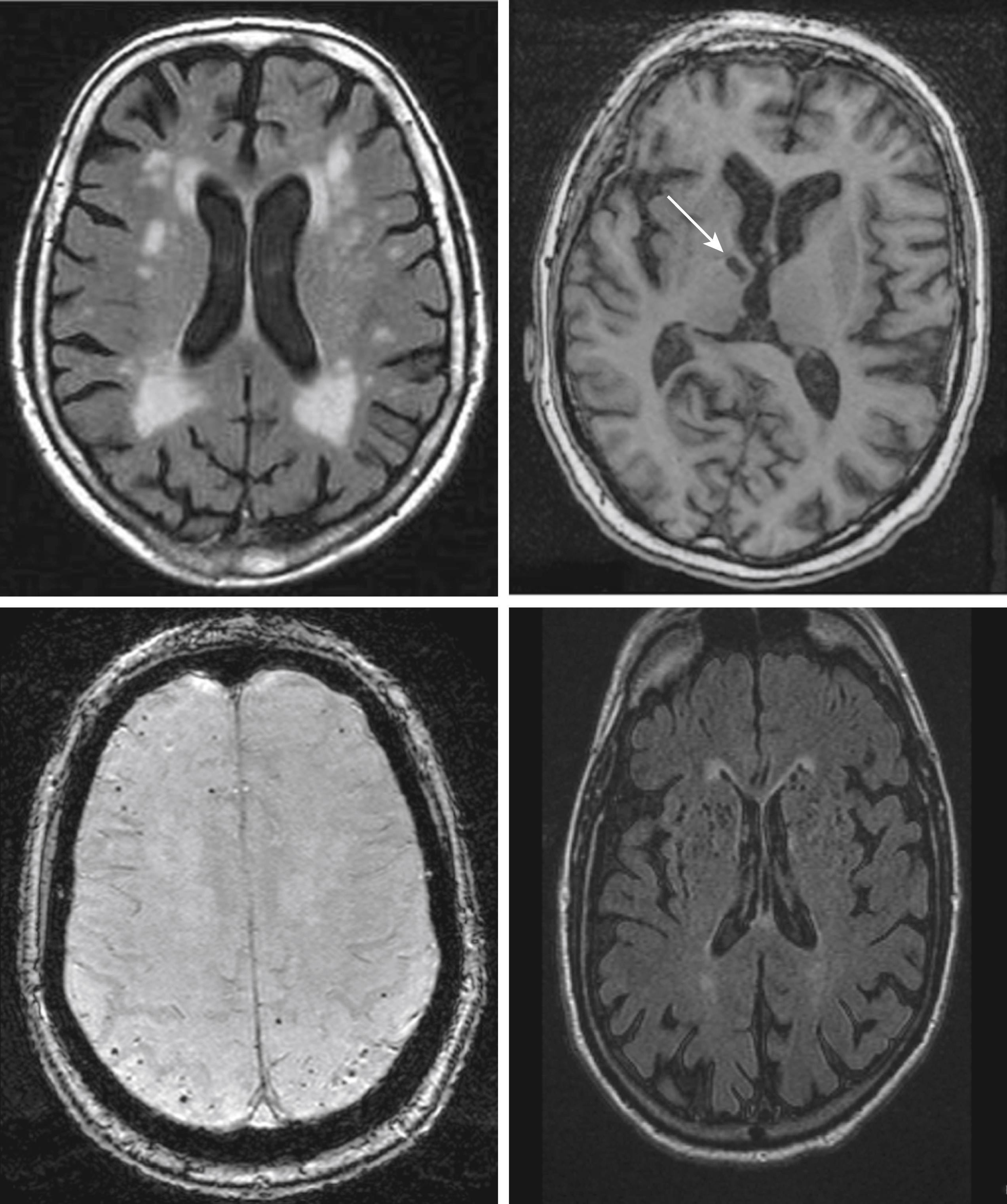 Fig. 18.2, Brain MRI images showing typical examples of findings in persons with vascular cognitive impairment; clockwise from top left: white matter hyperintensities, lacunar infarct, cerebral microbleeds, and enlarged perivascular (Virchow-Robin) spaces.