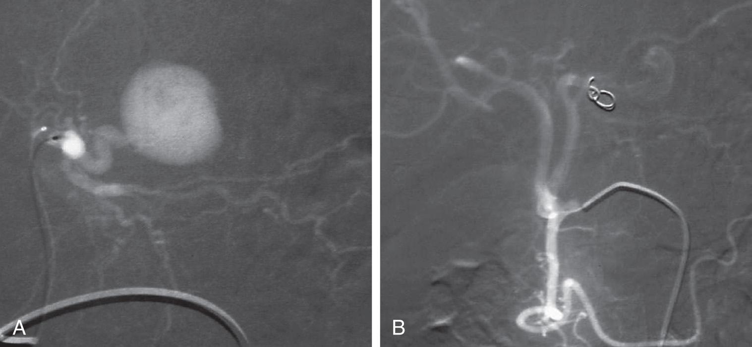 FIGURE 129.2, (A and B) Transarterial catheter embolization of a traumatic pseudoaneurysm of the left hepatic artery.