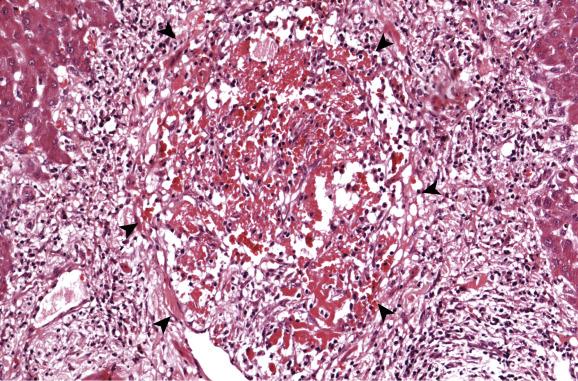 Fig. 12.4, Pylephlebitis.