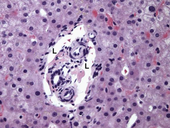 Fig. 12.5, Portal-vein absence in Abernethy malformation.