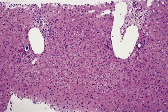 Fig. 12.6, Non-cirrhotic portal hypertension.