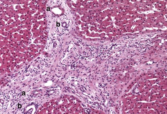 Fig. 12.7, Non-cirrhotic portal hypertension.