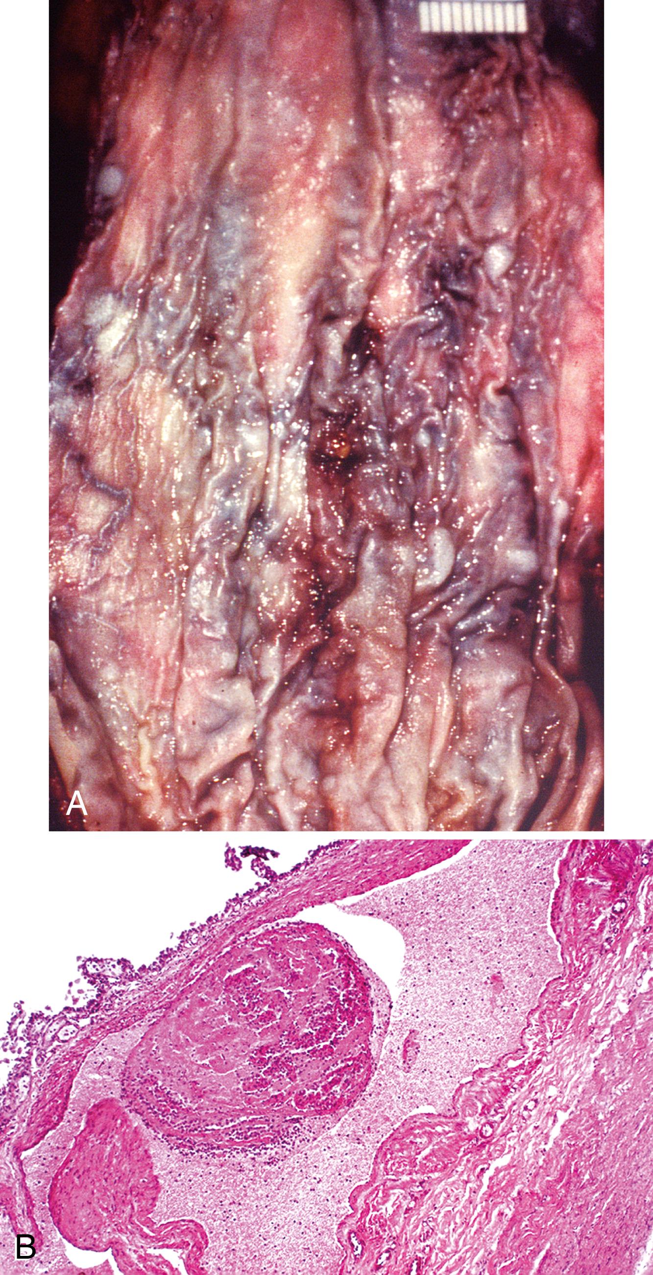 FIGURE 11.1, Esophageal varices.