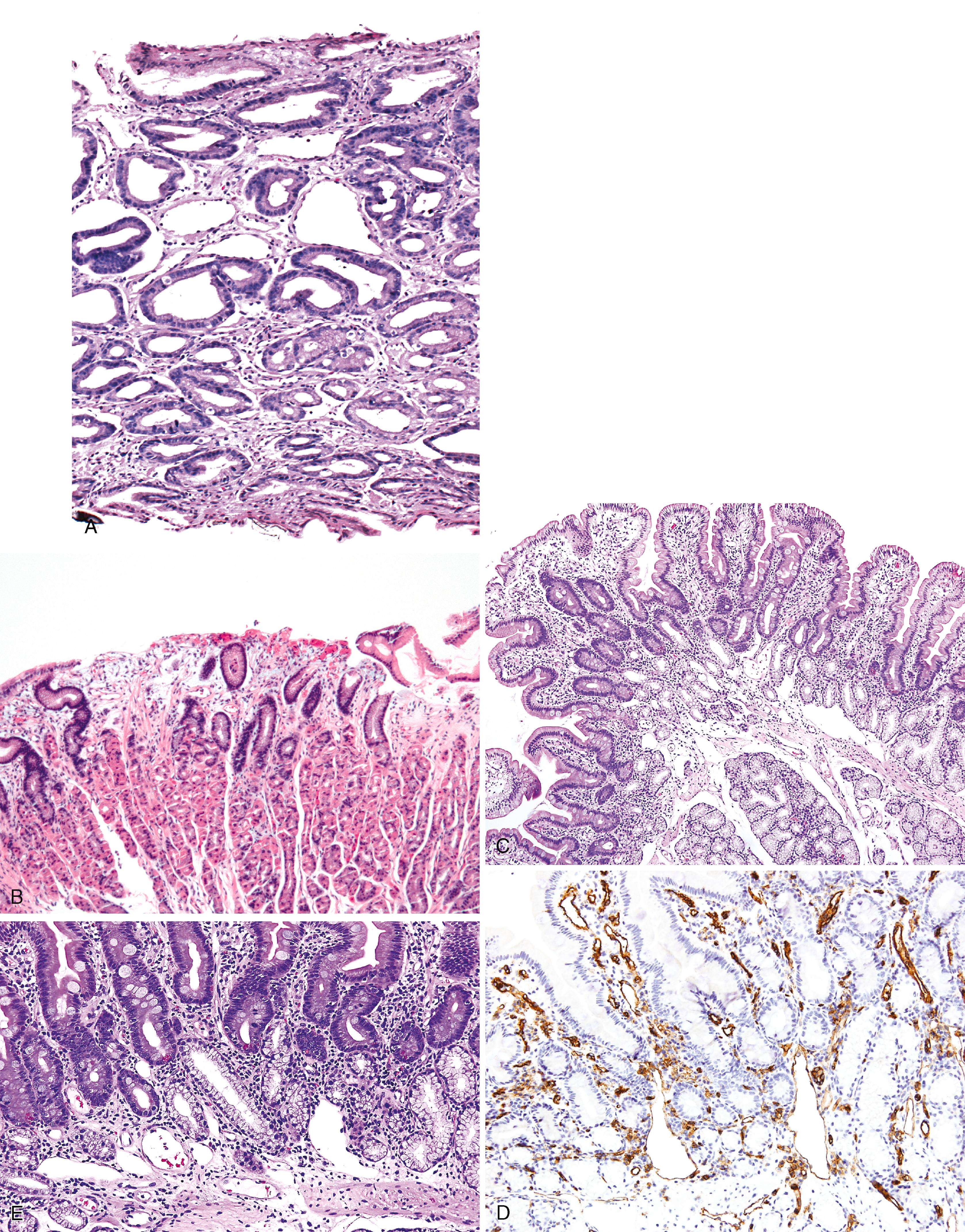 FIGURE 11.13, Portal hypertensive gastropathy.