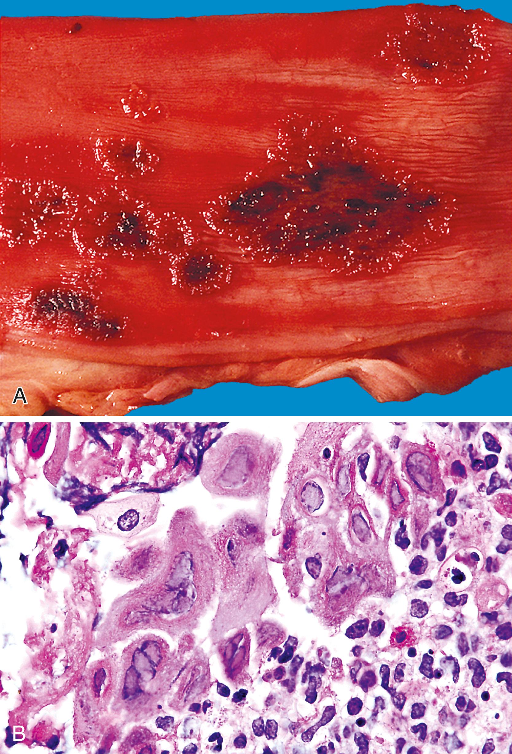 FIGURE 11.3, Herpes esophagitis. A, Multiple ulcers are present in the esophageal mucosa with hemorrhagic bases and erythematous, vesicular borders; notice the separate cluster of small erythematous vesicles. B, Characteristic multinucleate cells with Cowdry type A inclusions.