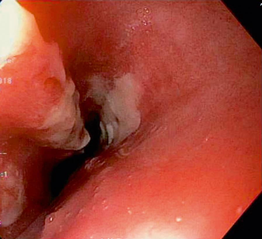 FIGURE 11.4, Endoscopic image of a broad-based esophageal ulcer associated with NSAID use.