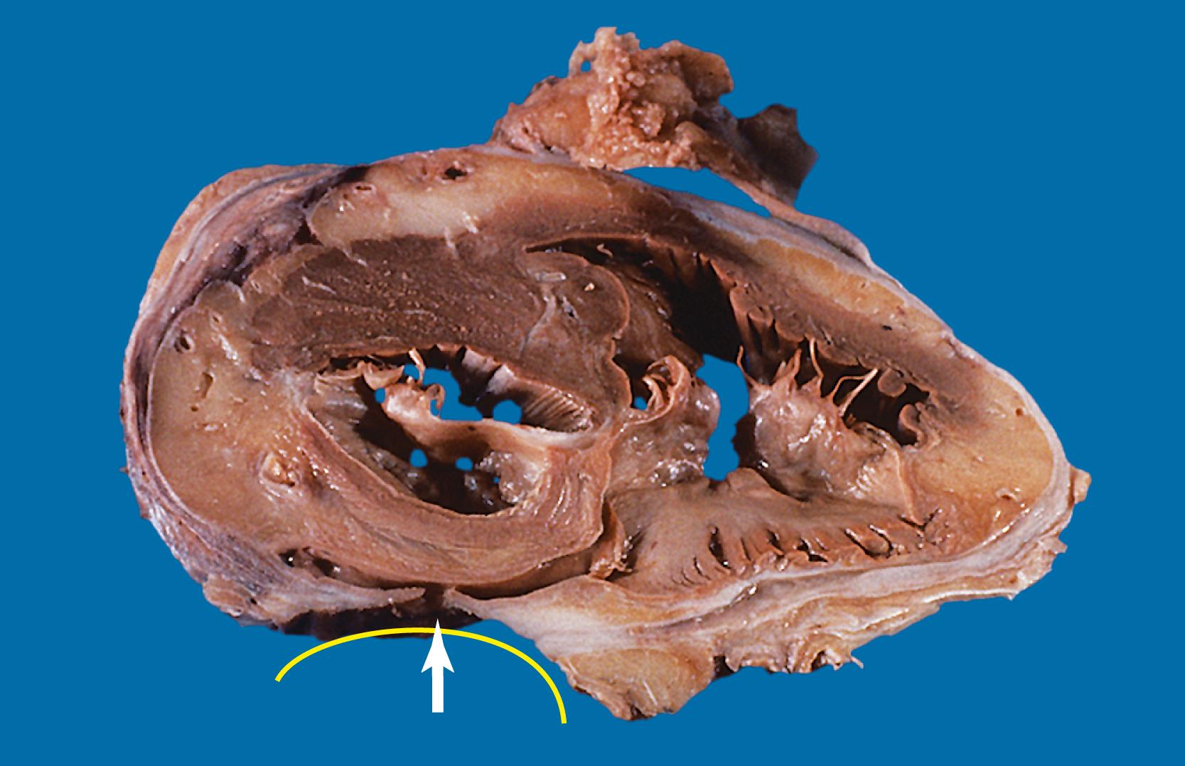 FIGURE 11.6, Ulcer into the heart.Coronal section of the heart with an adherent esophageal ulcer base (yellow line) and perforation into coronary sinus (arrow) that resulted in massive upper gastrointestinal bleeding.