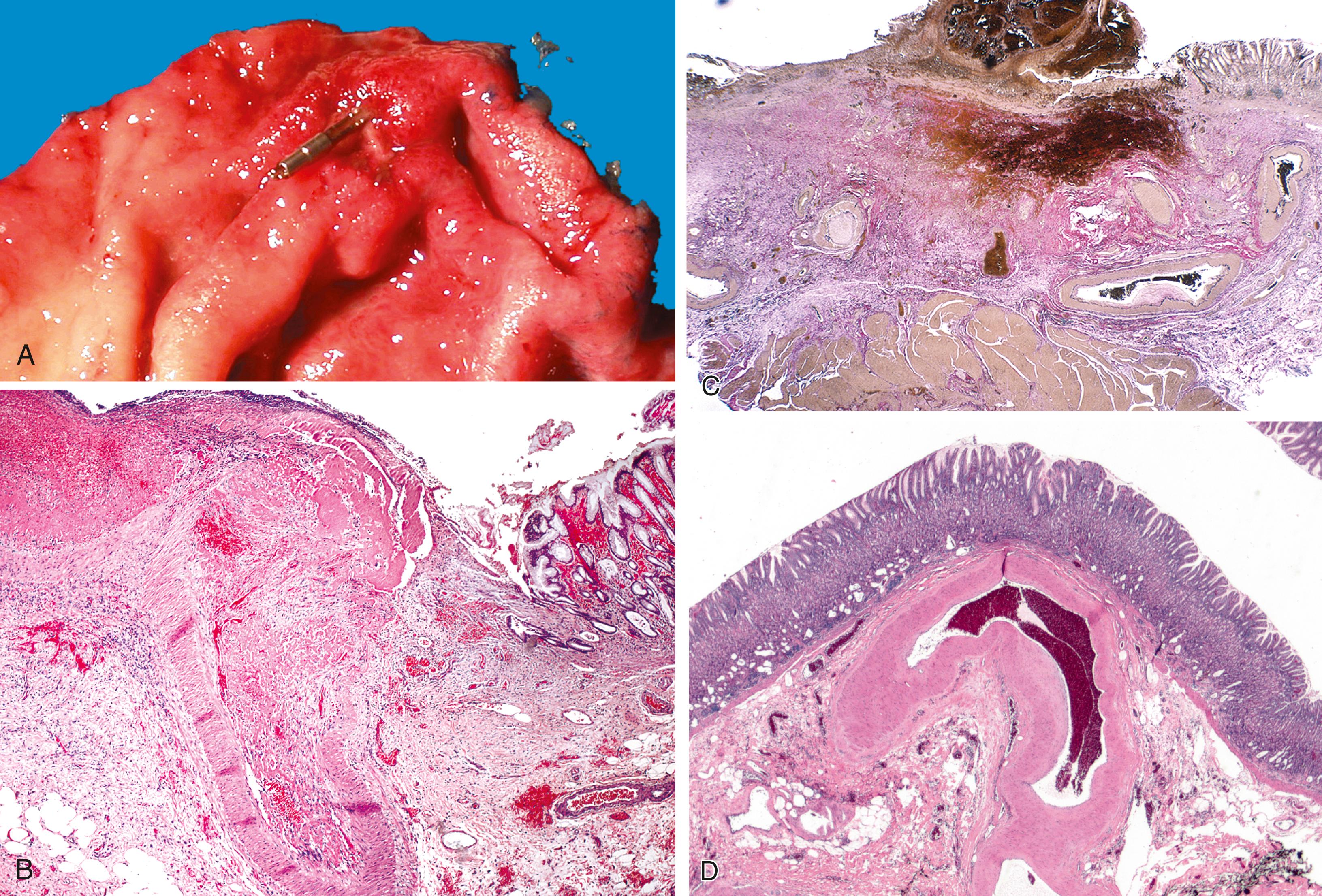 FIGURE 11.9, Dieulafoy lesion.