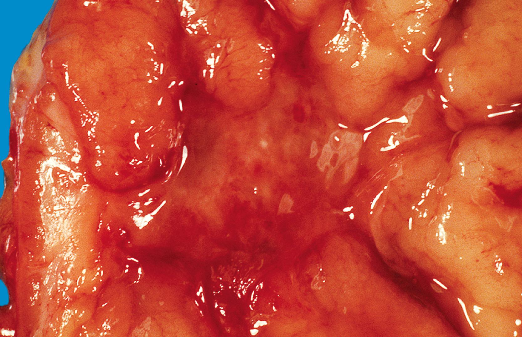 FIGURE 11.10, Centrally ulcerated gastric lymphoma.