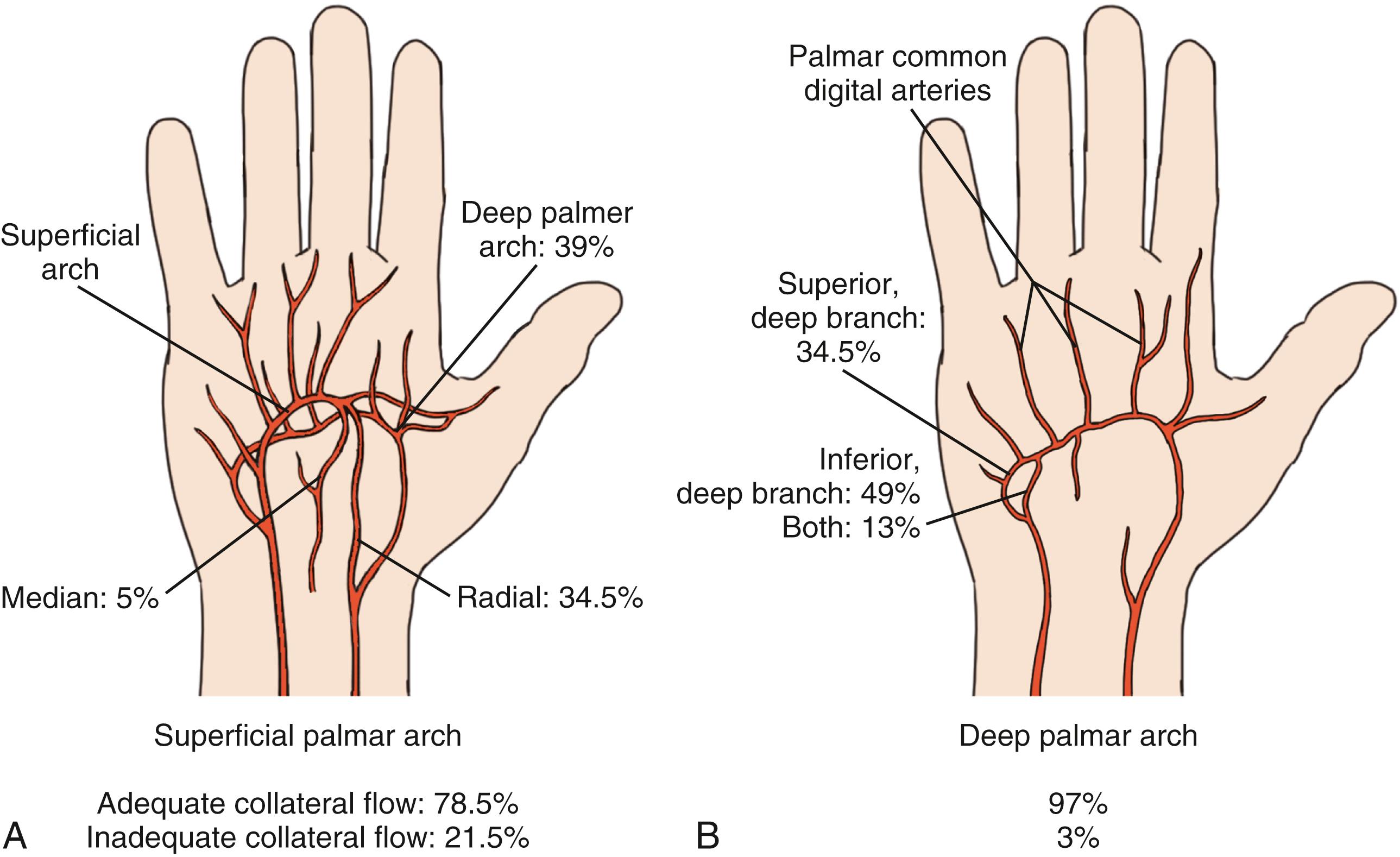 Fig. 60.1, A and B, The superficial palmar arch is “completed” by branches from the deep palmar arch, radial artery, or median artery in 78.5% of patients; the remaining 21.5% are “incomplete.” The deep palmar arch is “completed” by the superior branch of the ulnar artery, the inferior branch of the ulnar artery, or both in 98.5% of patients.