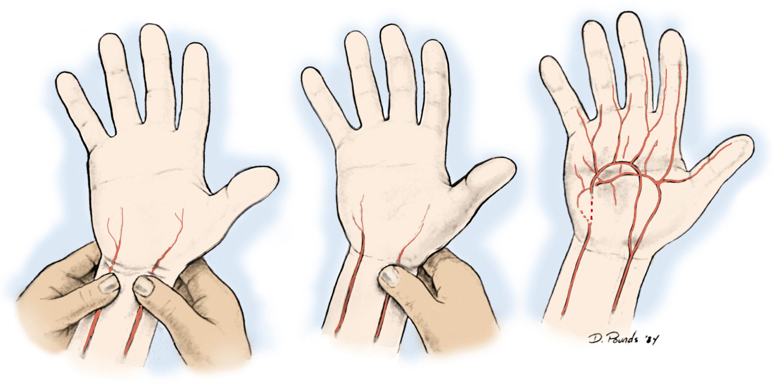 Fig. 60.2, The Allen test is represented schematically. Blood is exsanguinated from the hand, and both the radial and ulnar arteries are compressed (left) . After release of the ulnar artery (middle) , no blood flows through the occluded artery, and the palm remains pale. With release of the radial artery (right) , the entire hand will fill rapidly through the radial artery if the arch is complete. The order of the testing maneuvers can be reversed to evaluate the radial artery in a similar fashion. The test is best described as demonstrating flow or no flow through a specific artery.