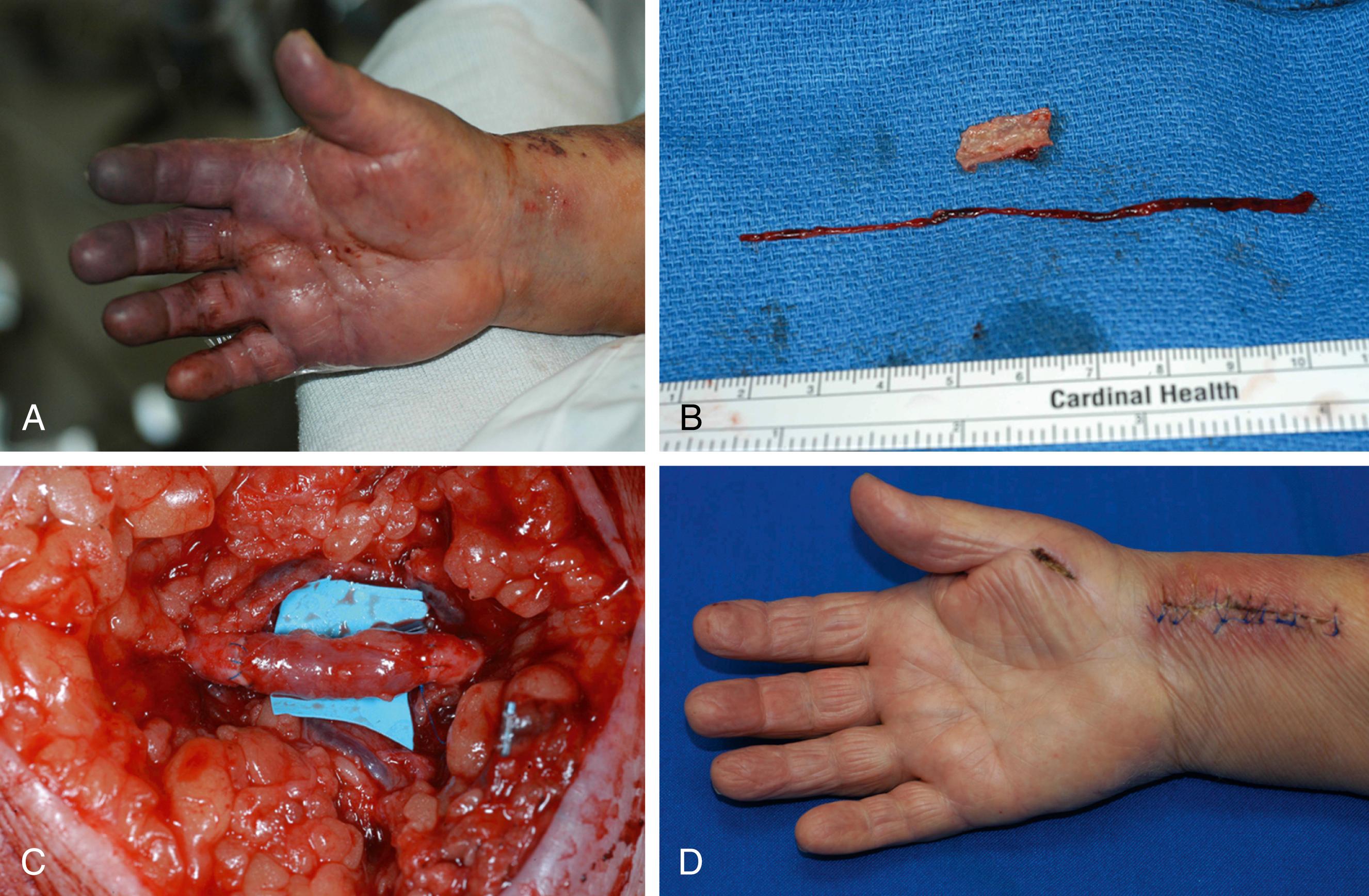 Fig. 60.3, A, View of an 82-year-old female’s hand 36 hours after attempted radial arterial line placement during surgery. There was no Doppler signal in the distal–radial artery or in the snuffbox. B, View of damaged portion of arterial wall removed and thrombus extracted with Fogarty® balloon catheter. Radial artery was heavily calcified. C, Radial artery after repair with “Longmire” vein segment patch graft. D, View of hand at 2 weeks after repair.