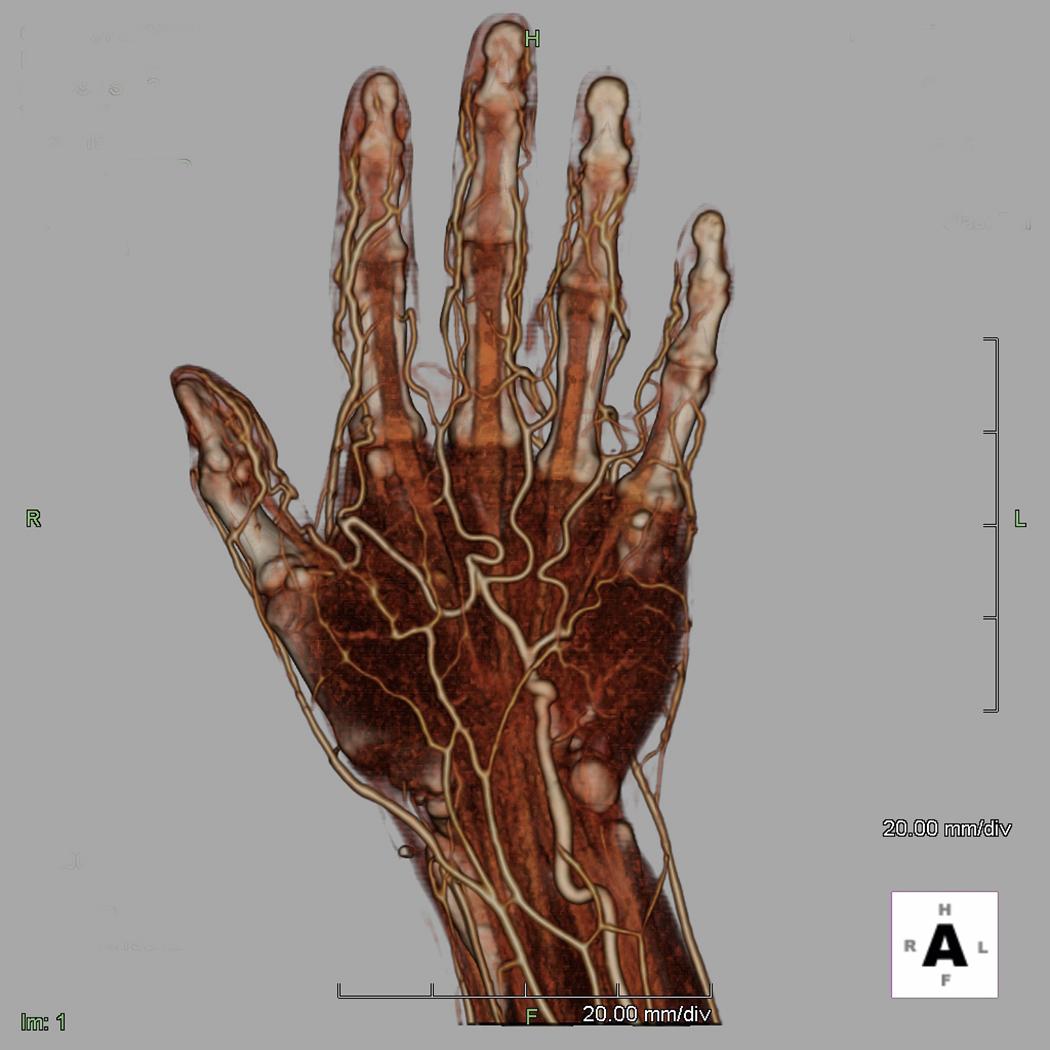 Fig. 60.4, Computed tomography angiography of palm showing level of detail that can be obtained.