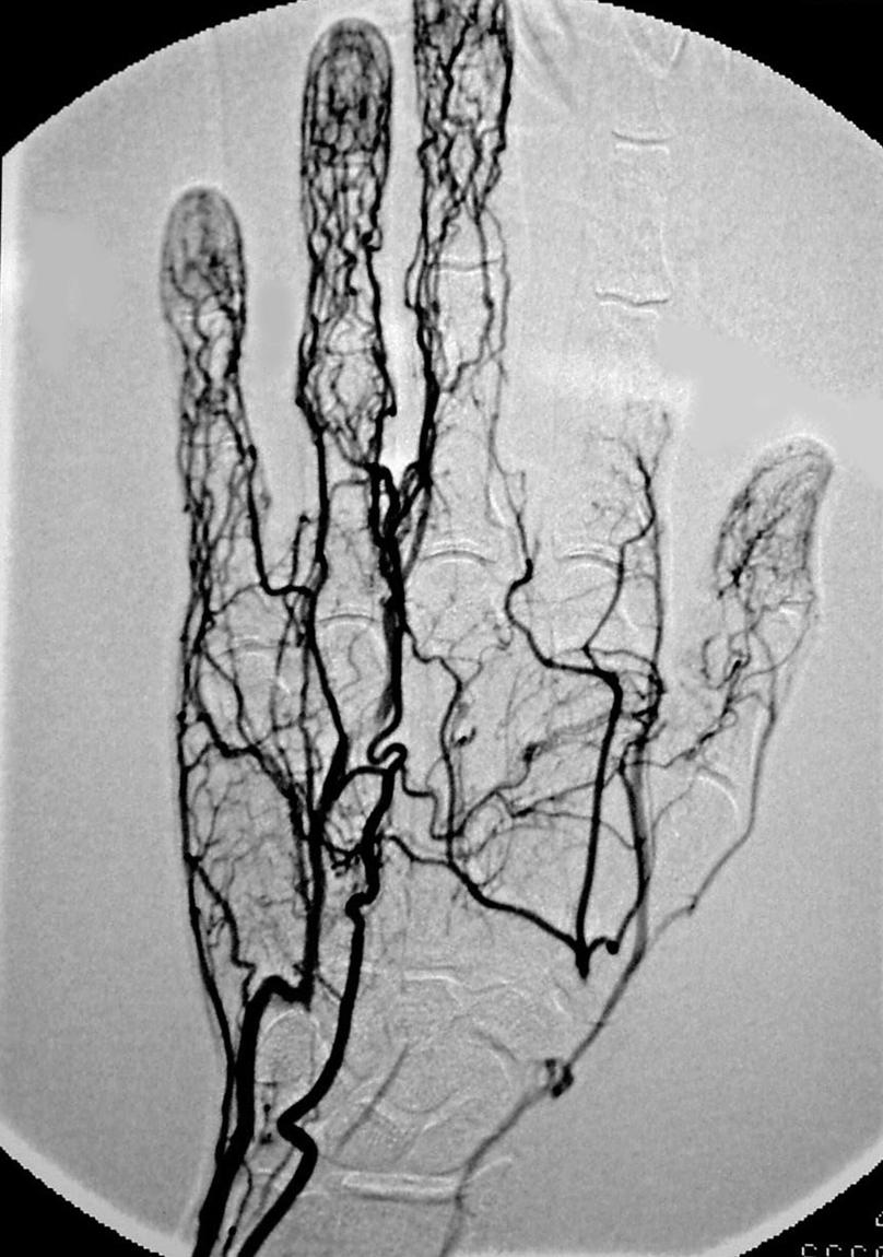 Fig. 60.5, Arteriogram of patient with recent onset of ischemic symptoms of the thumb and index finger. This was read as a normal variant with a large median artery when in fact the patient had suffered thrombosis of the radial artery in the anatomic snuffbox and embolization to the thumb and index finger.