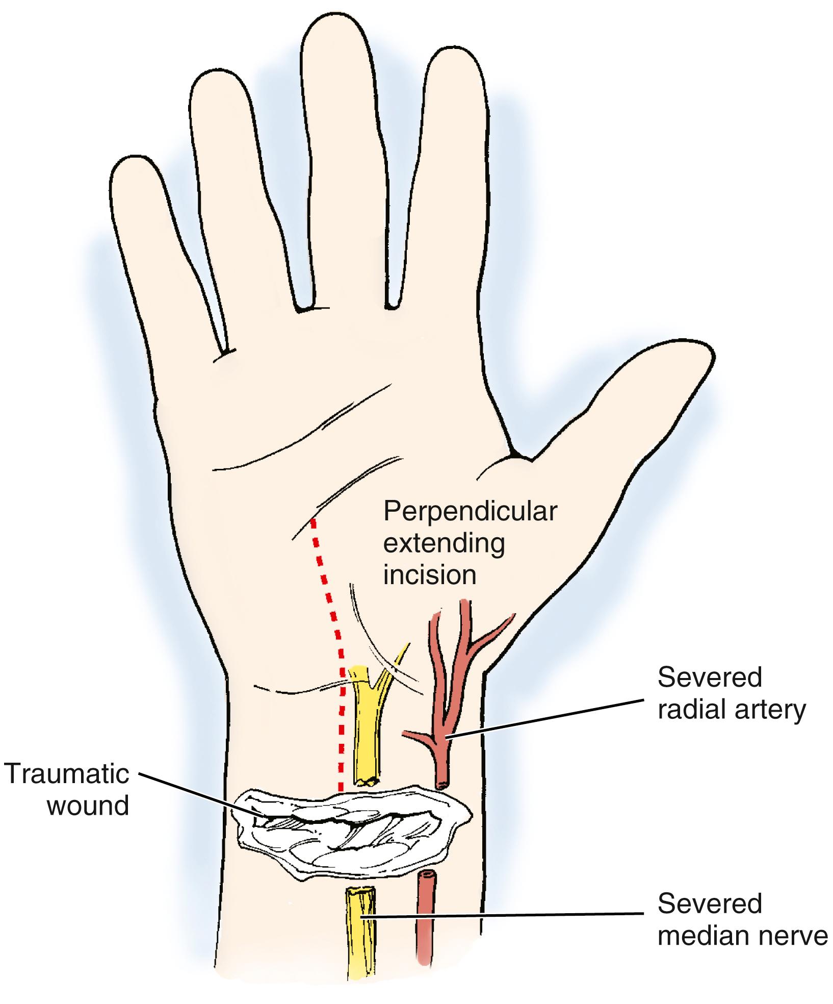 Fig. 60.6, Schematic representation of treatment of a traumatic wound involving transection of the radial artery and median nerve. During arterial reconstruction, transverse wounds may be extended by perpendicular longitudinal incisions to facilitate exposure and protect repaired structures when wound closure is not possible.