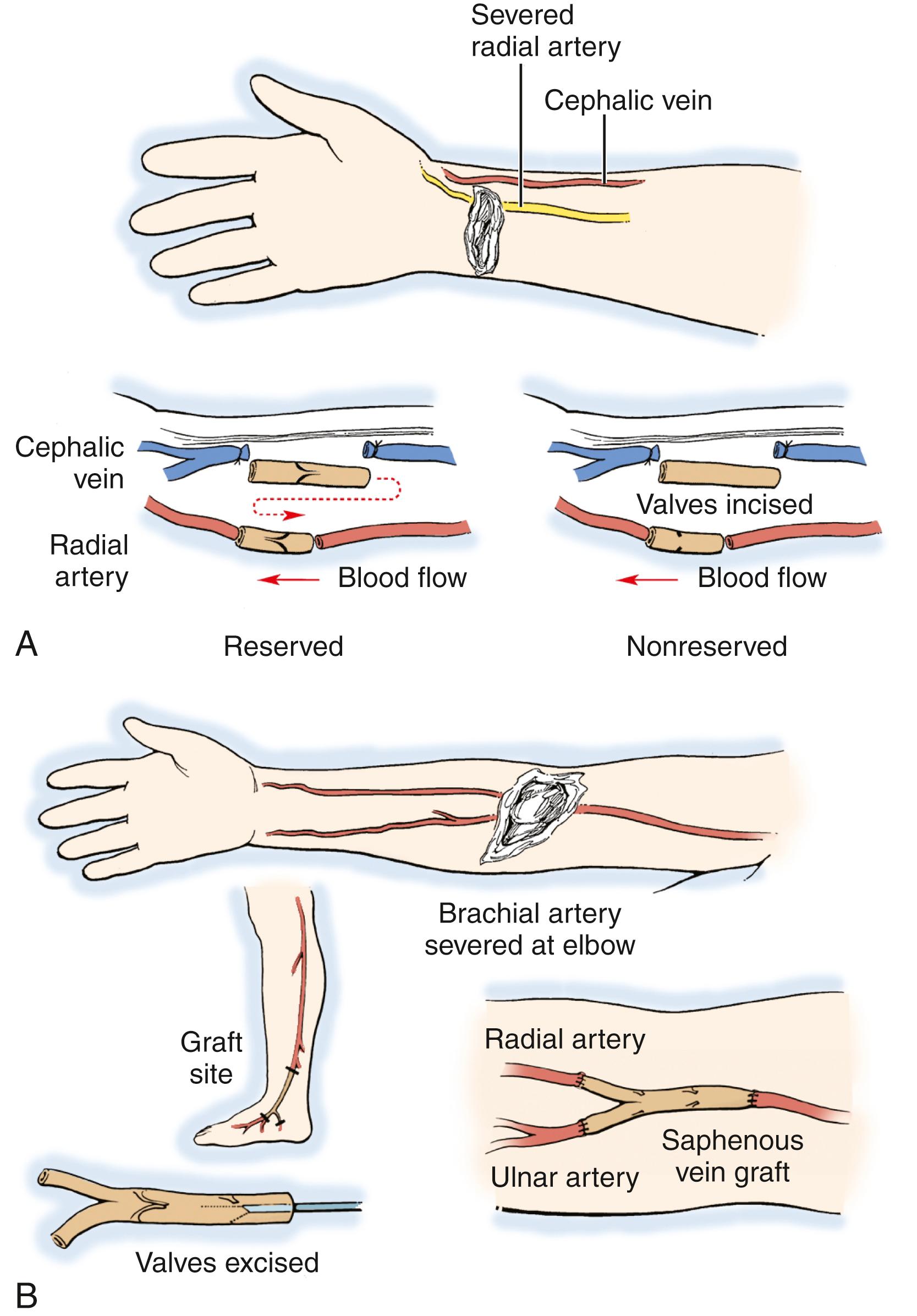 Fig. 60.7, A, Interposition vein grafting may be used to repair damaged arterial segments that would be under tension with an end-to-end repair. Reversed interposition grafts may be obtained from local veins (e.g., cephalic) after reversal. Alternatively, nonreversed veins may be used if the valves are incised (lower right) . B, Severe injuries that involve the brachial artery or the radial and ulnar arteries can be managed by branched vein grafts. Either reversed interposition or nonreversed (with valves incised) interposition vein grafts may be used.