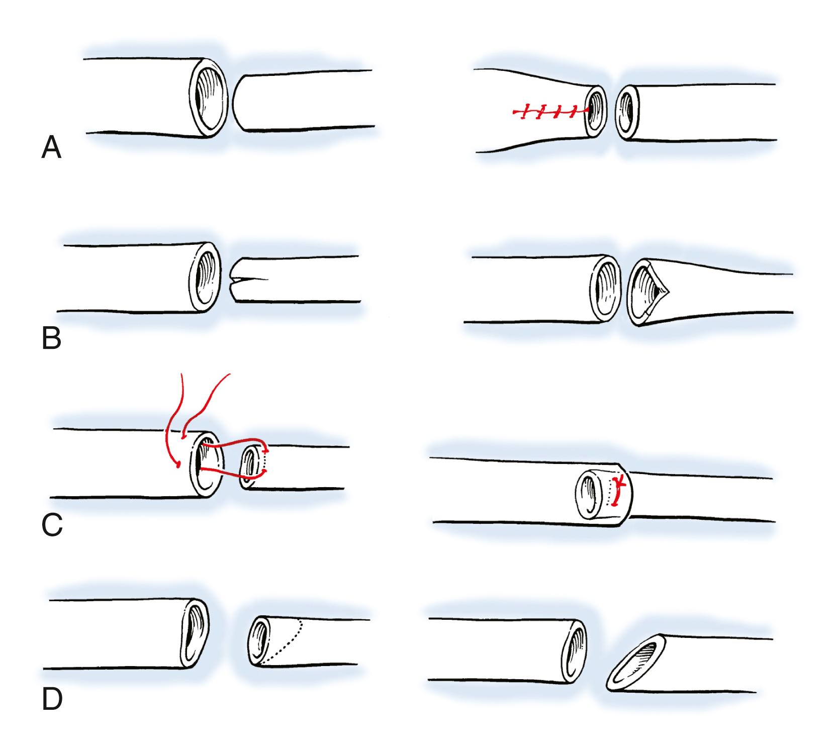 Fig. 60.8, Mechanisms to overcome size discrepancies during arterial repair. A, The larger vessel may have a “V”-shaped portion excised and then be closed. B, Conversely, the smaller vessel may be split longitudinally and then expanded to fit the larger vessel. C, If the smaller vessel provides proximal inflow, it may be intussuscepted into the larger vessel via a sleeve-type technique. D, Small discrepancies can be managed by making a 30-degree angled or beveled cut of the smaller vessel followed by gentle dilation.