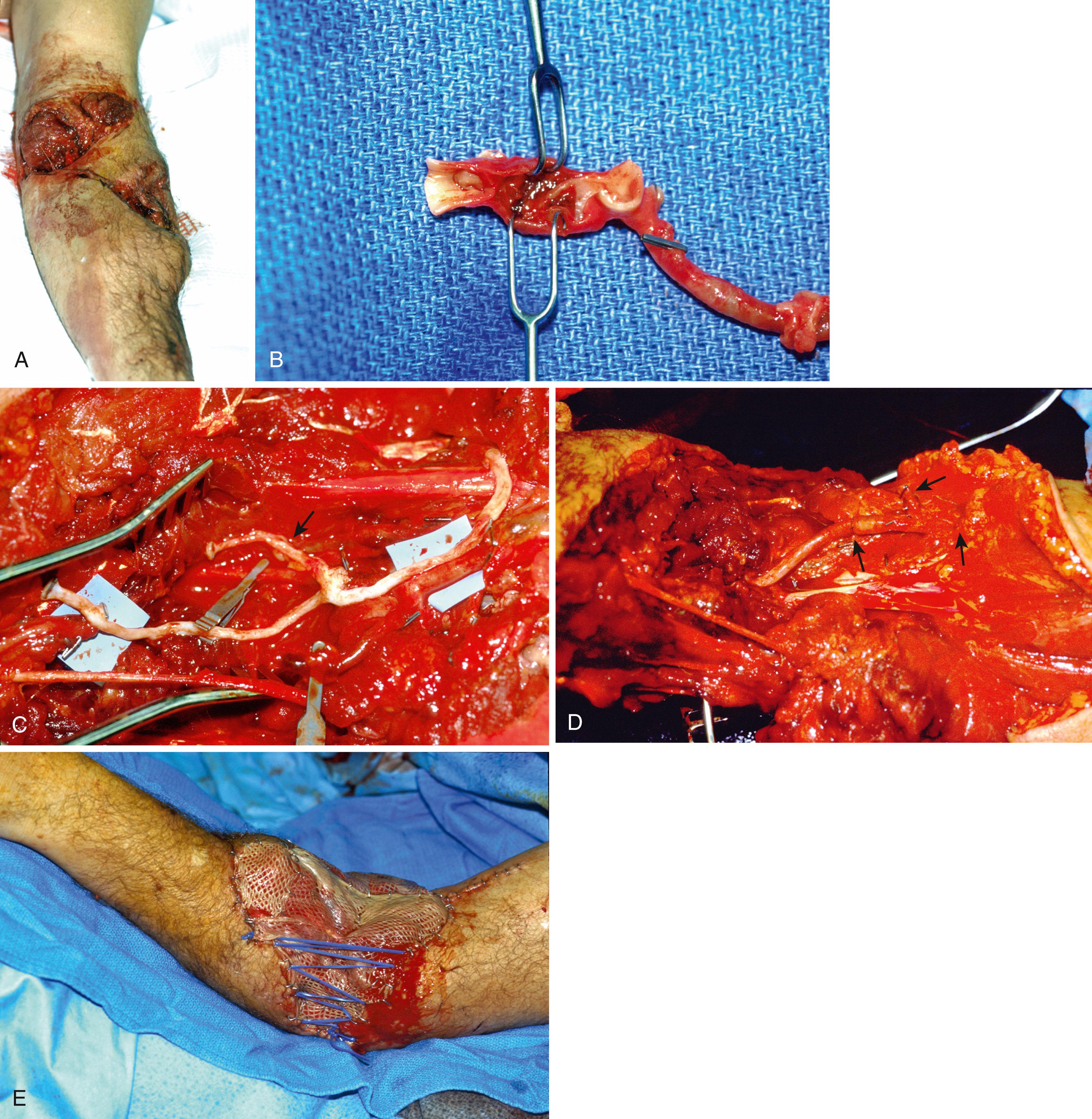 Fig. 60.10, A, Patient who suffered avulsive injury to forearm with brachial artery injury. B, View of brachial artery after resection of damaged portion; note intimal injury. C, Vein graft placed in arm prior to anastomosis, graft with branch selected (arrow) for anastomosis to free flap for coverage. D, Vein graft after anastomoses. Small arrows show anastomoses; large arrow shows branch that will be used for anastomosis to free rectus abdominis muscle flap. E, Muscle flap sewn in with skin graft.