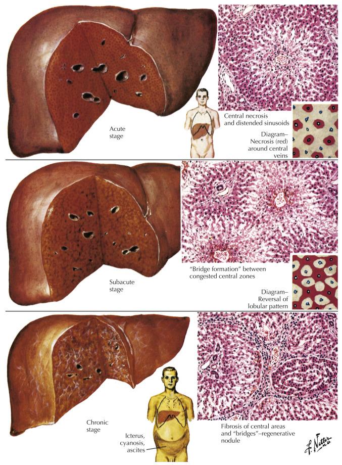 Fig. 180.1, The Liver in Heart Failure: Cardiac Liver and Shock.