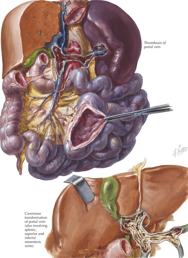 Fig. 180.2, Portal Venous Obstruction.