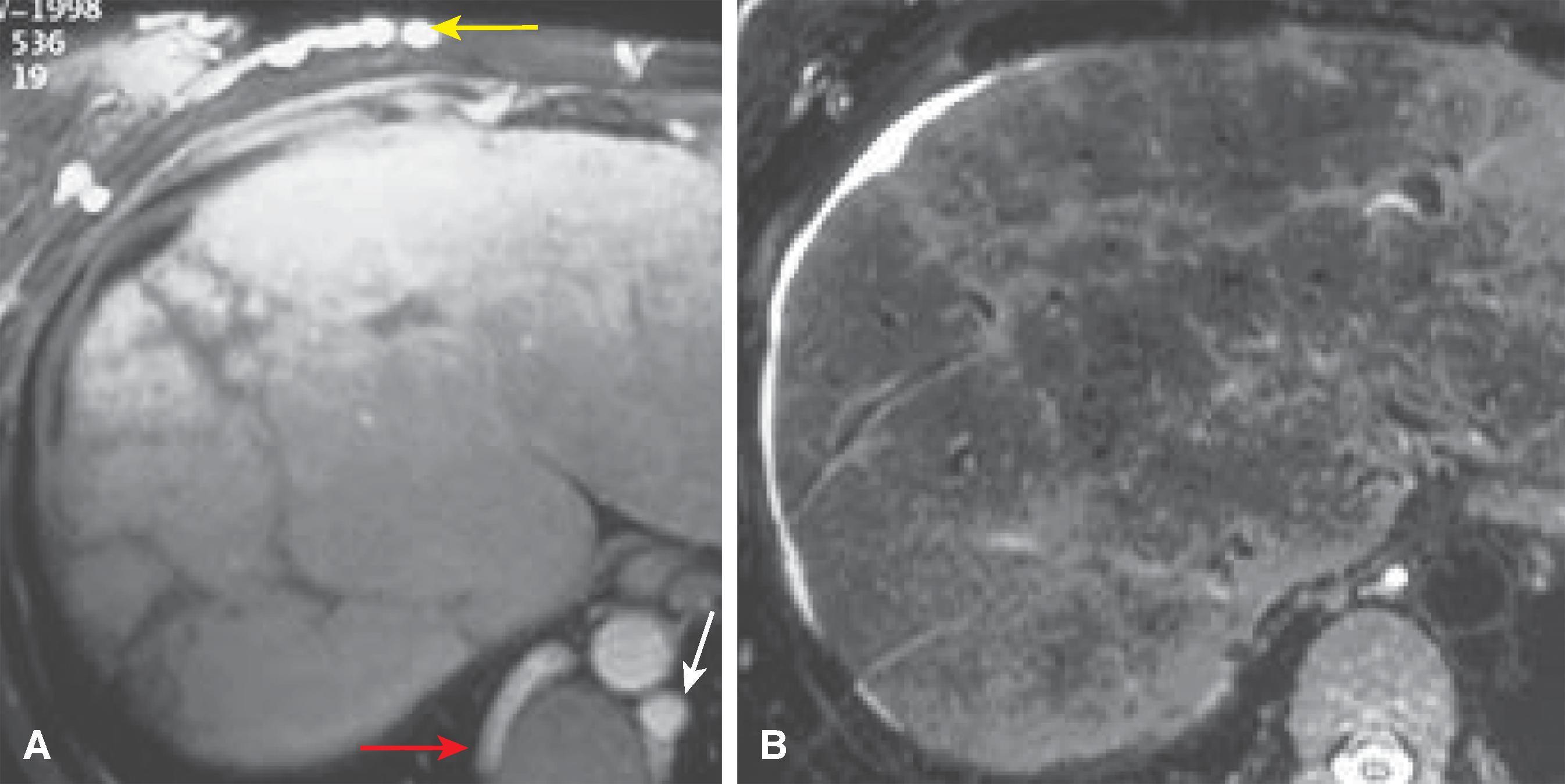 Fig. 57.11, Chronic Budd-Chiari syndrome: magnetic resonance imaging findings.