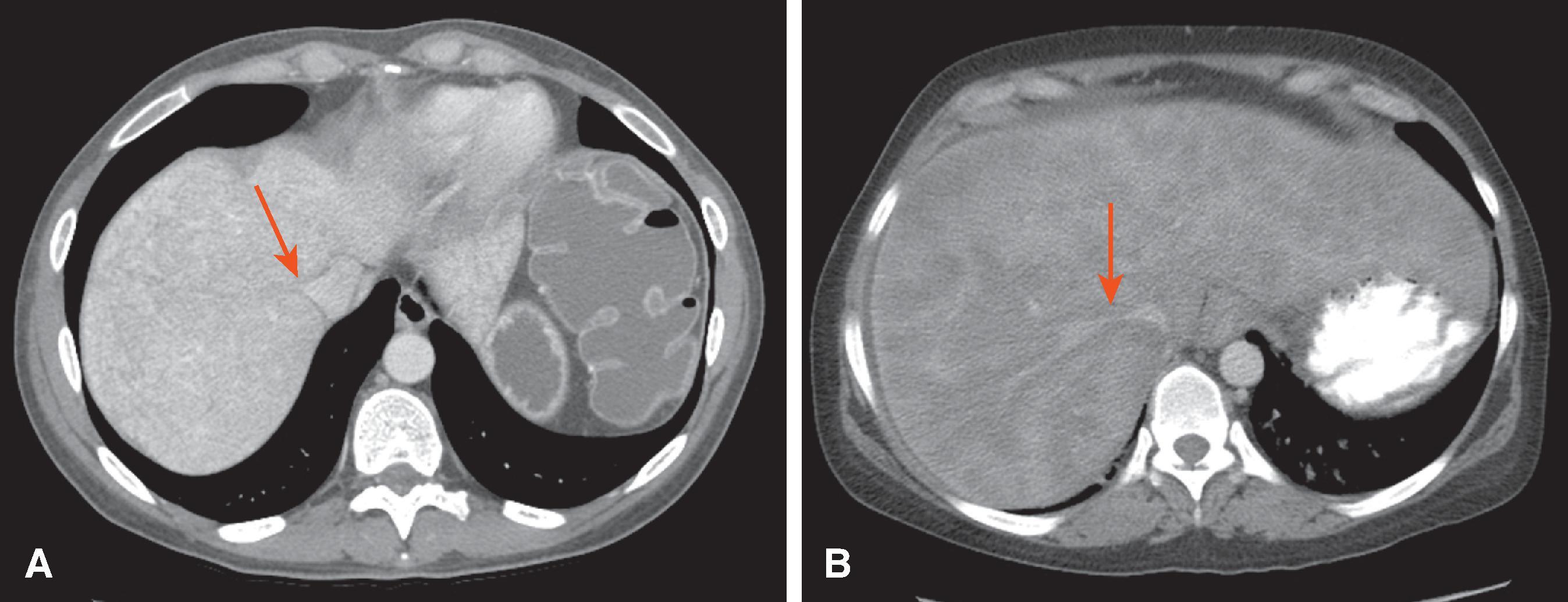 Fig. 57.12, Sinusoidal obstruction syndrome: computed tomography (CT) findings.