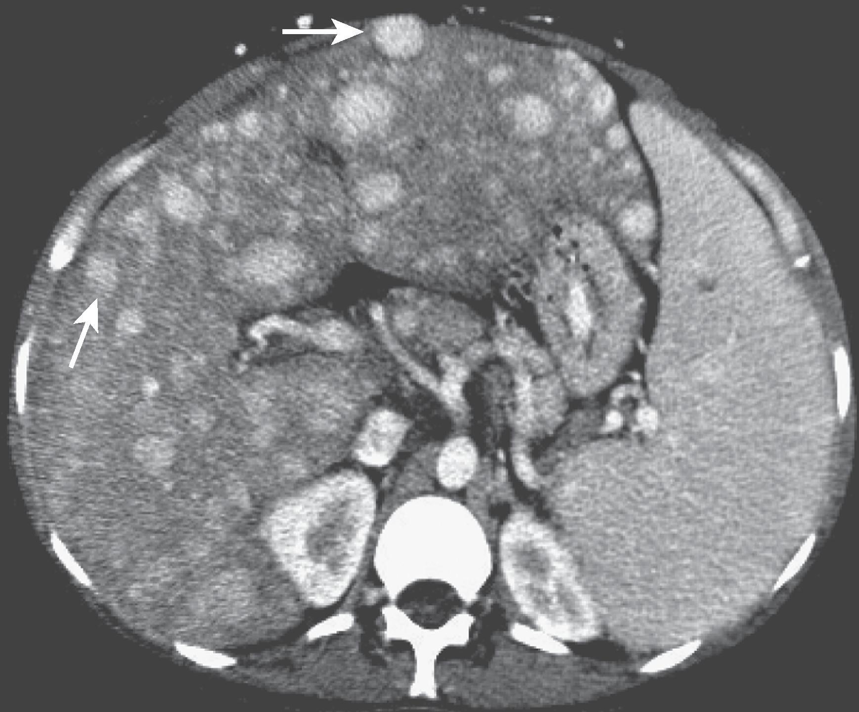 Fig. 57.13, Budd-Chiari syndrome: nodular regenerative hyperplasia.