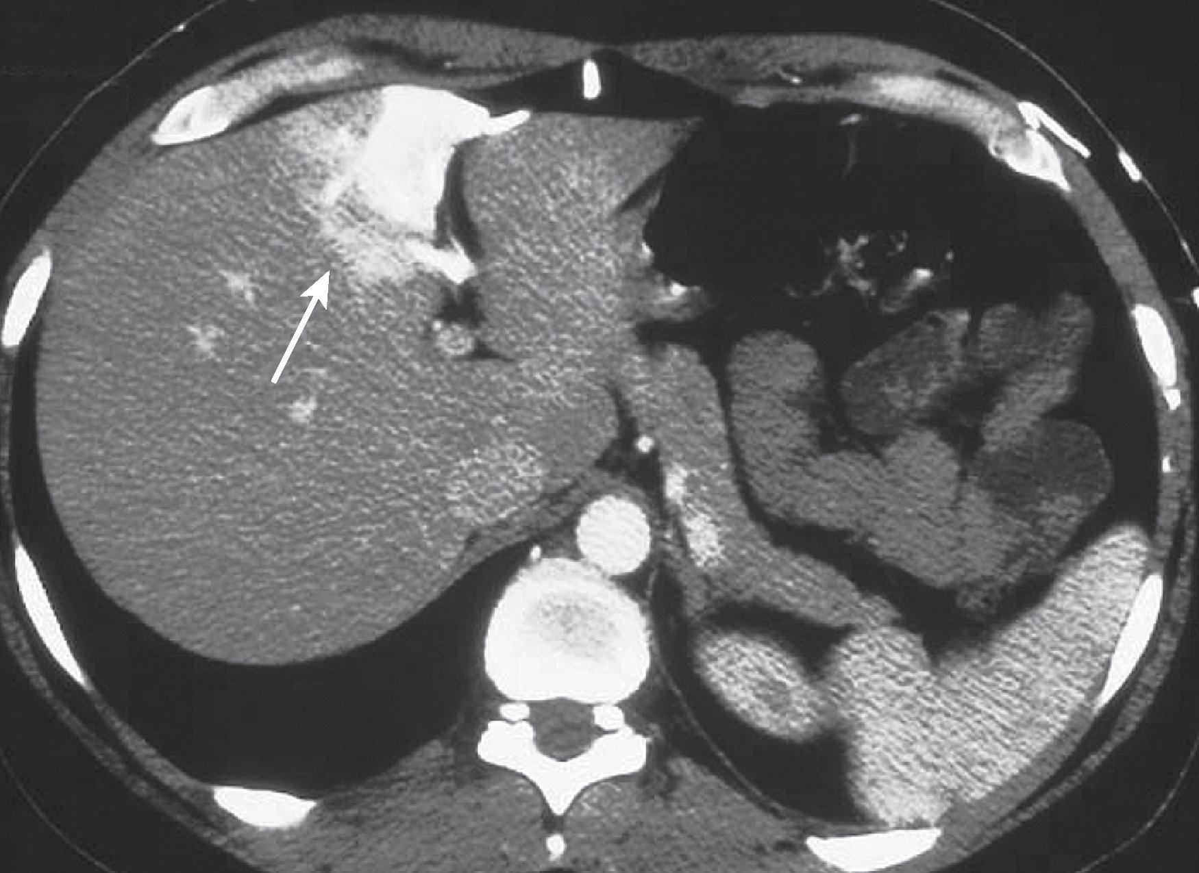 Fig. 57.5, Transient hepatic attenuation differences due to superior vena cava obstruction by lung cancer.